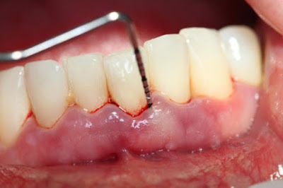 Các triệu chứng viêm chân răng thường gặp