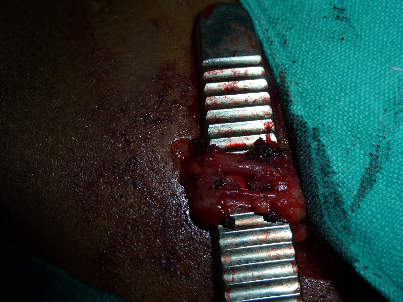 Ramayya Pramila Urology Hospital: CHRONIC TESTICULAR PAIN: A DIFFICULT