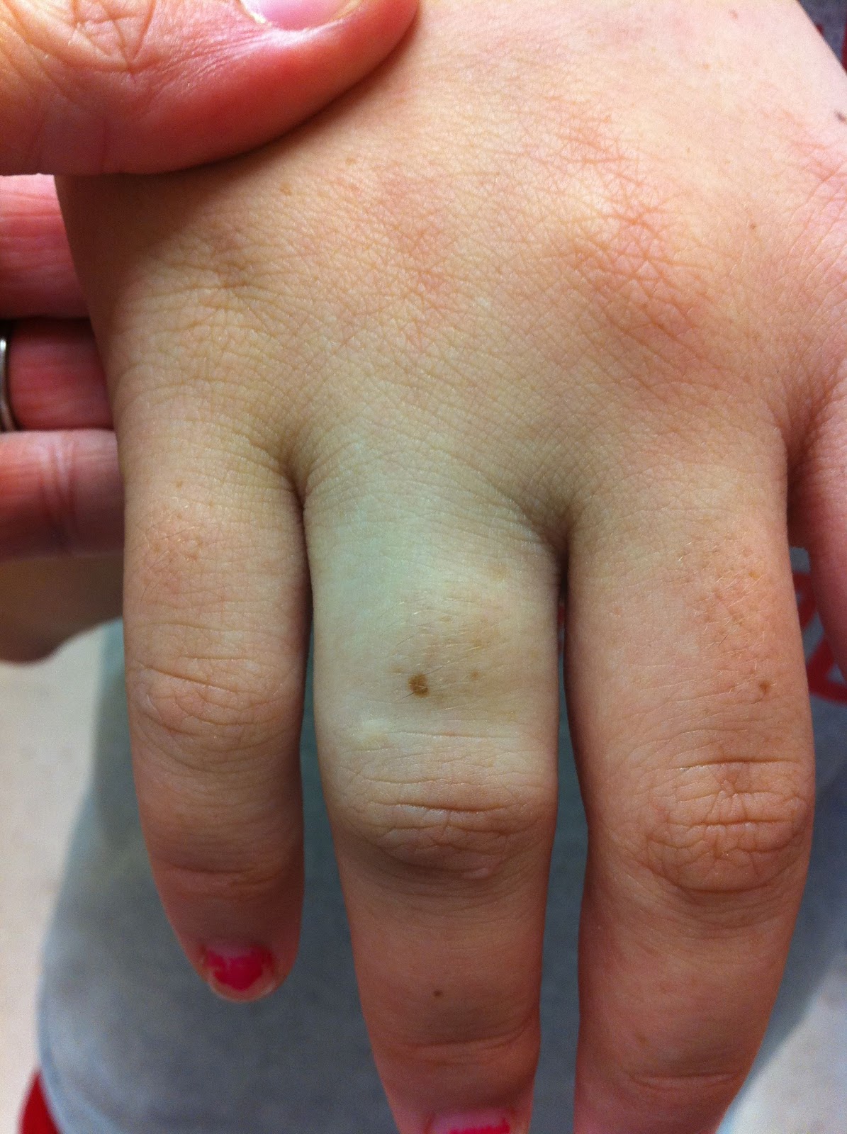 On the Go Another Broken Bone...Really???