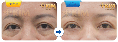 Lấy bọng mỡ mắt tại KIM Hospital được thực hiện với mức chi phí phải chăng.