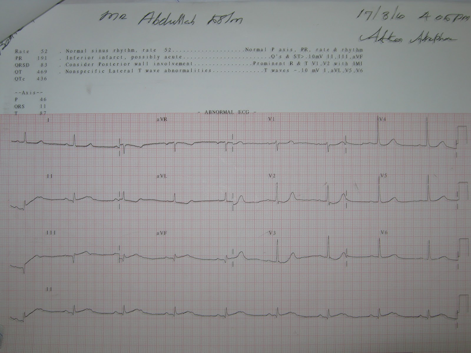 Medical Images Gallery Inferior Wall Myocardial Infarction ECG