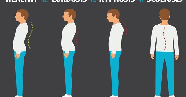 Apa Itu Kelainan Tulang Kifosis Skiliosis dan Lordosis ? - Baihaqi ...