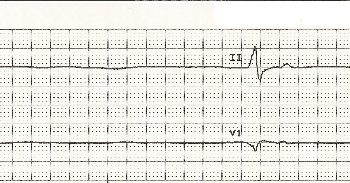 float nurse acls rhythms ventricular rhythms med surg nurse