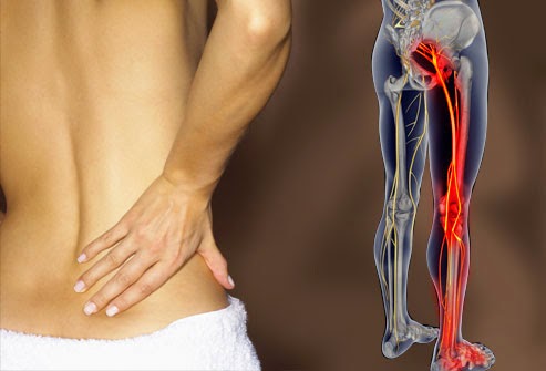 Sciatica nerve pain pattern of inflammation