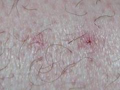 Bites 2 weeks after zapping Bites 2 weeks after zapping