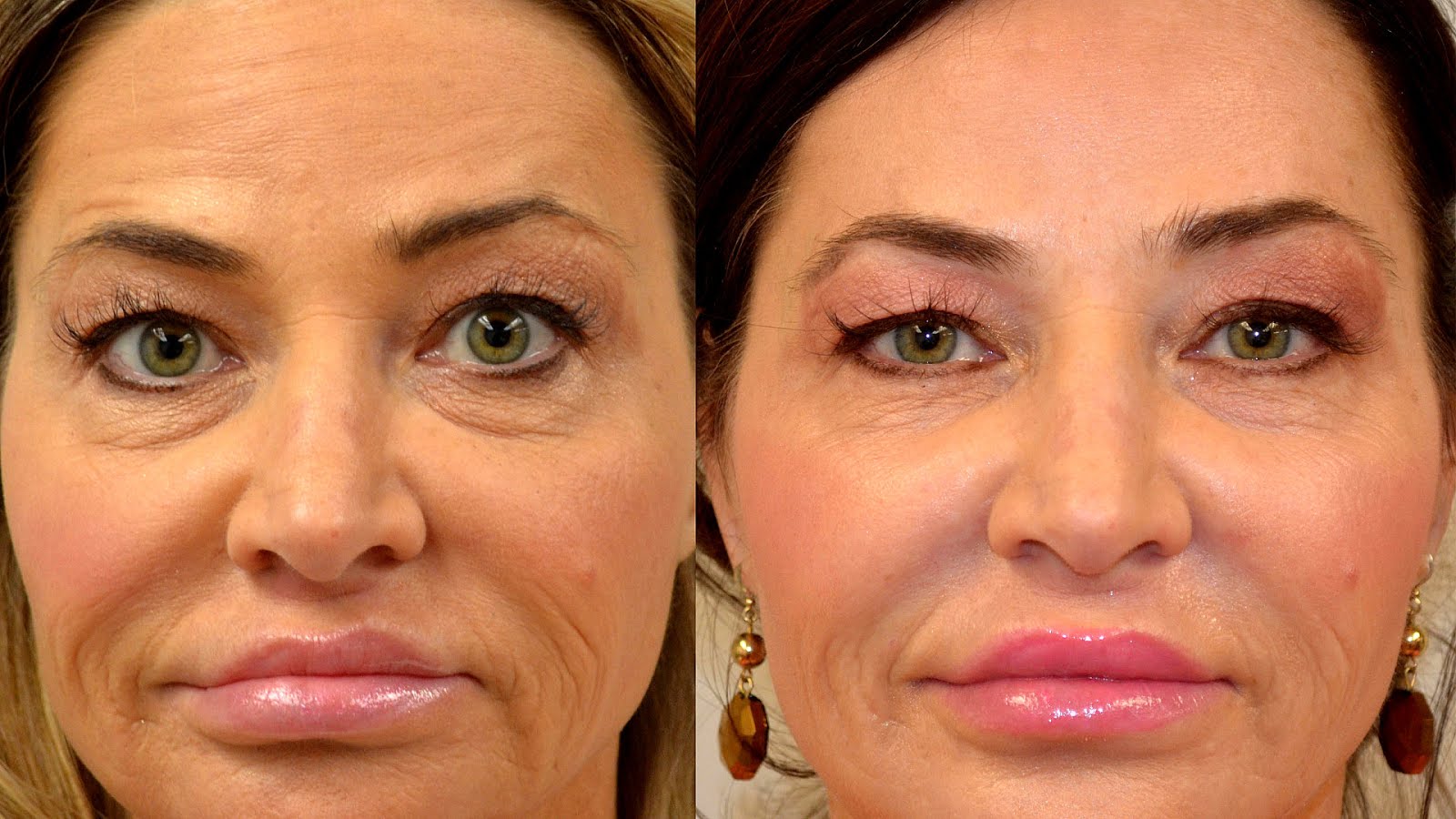 Non Surgical Face And Neck Lift Lift Choices