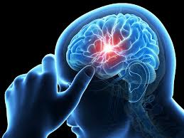 Cari Obat Sakit Stroke Ringan Paling Ampuh, Bagaimana Cara Alami Untuk Mengatasi Stroke Ringan?, cara mengobati penyakit stroke akut