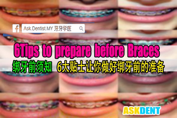 牙牙学医 绑牙前须知 6大贴士让你做好绑牙前的准备