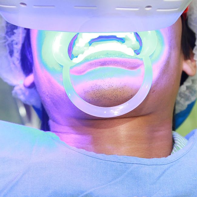 Kỹ thuật tẩy trắng răng bằng laser whitening có hại không