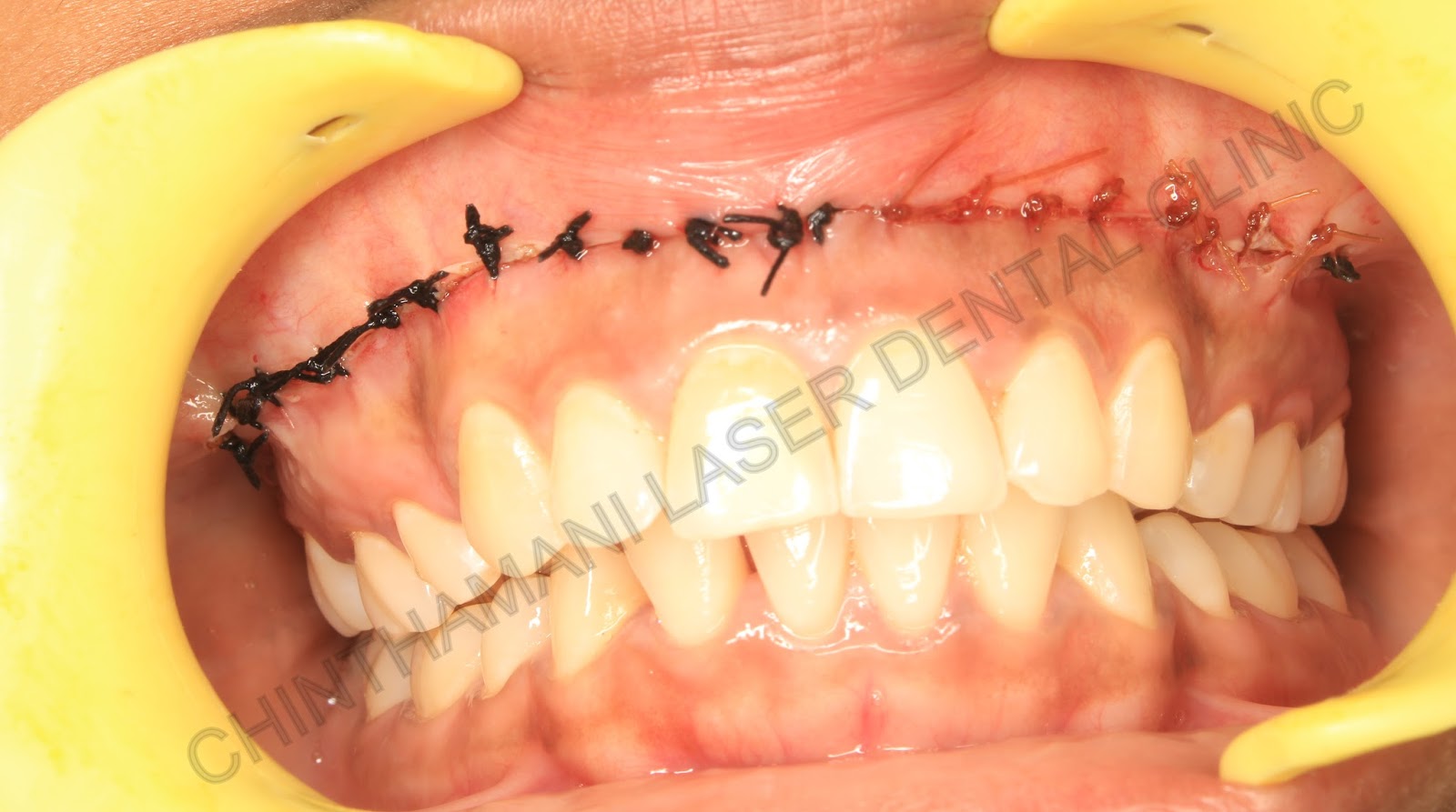 Chinthamani Laser Dental Clinic: LIP REPOSITIONING SURGERY FOR GUMMY ...