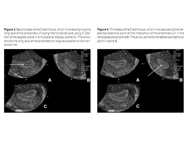 BÀI SOẠN VỀ SIÊU ÂM CHẨN ĐOÁN: 3D US for Uterine Anomalies: The Z Technique
