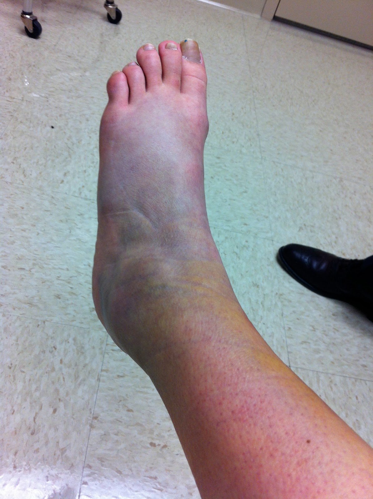 Diary of a Running Mom latest and greatest ankle injury pictures