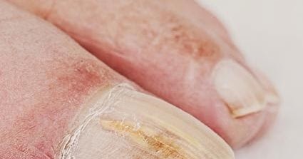 La tintura de alcohol del propóleos del hongo de las uñas las revocaciones