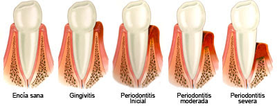 piorrea enfermedad periodontal periodontitis infeccion sangrado encia