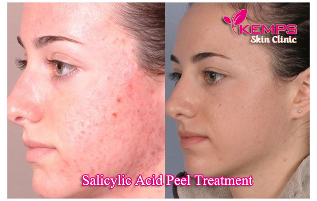 Think About Salicylic Acid Peels And How Salicylic Acid Peels Help The think-about-salicylic-acid-peels-and-how-salicylic-acid-peels-help-the