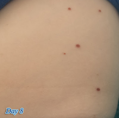 Day 8  Photos of Chicken Pox in their various stages