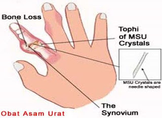 Solusi Mengatasi Penyakit Asam Urat, Gambar Pembentukan Asam Urat, Gejala Asam Urat Pencegahan Dan Pengobatannya, Implementasi Askep Asam Urat, Mengobati Lutut Bengkak Karena Asam Urat, Obat Asam Urat Di Warung, Kolesterol Asam Urat Glukosa Normal, Obat Asam Urat Alami Dari Tanaman, Bagaimana Cara Menyembuhkan Asam Urat, Asam Urat Itu Berbahaya Kah, Cara Mengobati Asam Urat Dengan Labu Siam, Makanan Untuk Penderita Asam Urat Akut, Coklat Bikin Asam Urat, Asam Urat Dan Coklat, Testimoni Asam Urat Transfer Factor, Asam Urat Pinggang Sakit, Menghilangkan Asam Urat Tanpa Obat, Jika Asam Urat Dan Kolesterol Tinggi, Manfaat Air Kelapa Untuk Penyakit Asam Urat, Cara Mengobati Rematik Dan Asam Urat Secara Alami, Buah Yang Baik Untuk Asam Urat Dan Kolesterol, Asam Urat Cara Mengatasinya, Obat Asam Urat Yang Ampuh Dan Alami, Cara Mengatasi Asam Urat Pada Kaki, Perbedaan Asam Urat Dan Kolesterol Tinggi, Cara Menurunkan Sakit Asam Urat, Persiapan Cek Asam Urat, Obat Herbal Asam Urat Darah Tinggi Kolesterol, Gambar2 Asam Urat, Obat Paling Ampuh Penyakit Asam Urat 