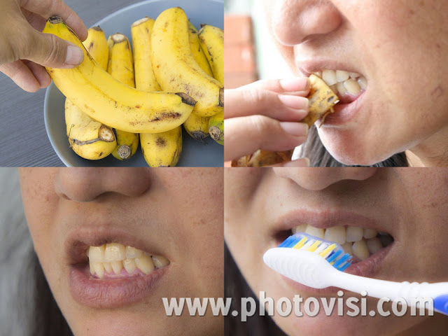 أسرع طريقة لتبييض الأسنان باستخدام قشر الموز