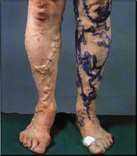 Mkb 10 varicoză Mâncărime sub genunchi din spate cu varicoză