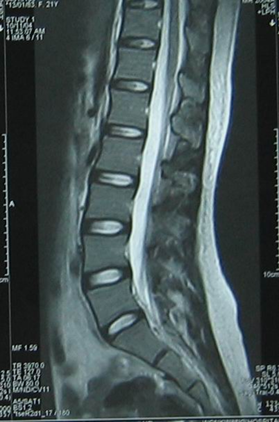 Acupuncture and Rehabilitation ( Road to full recovery) Lumbar