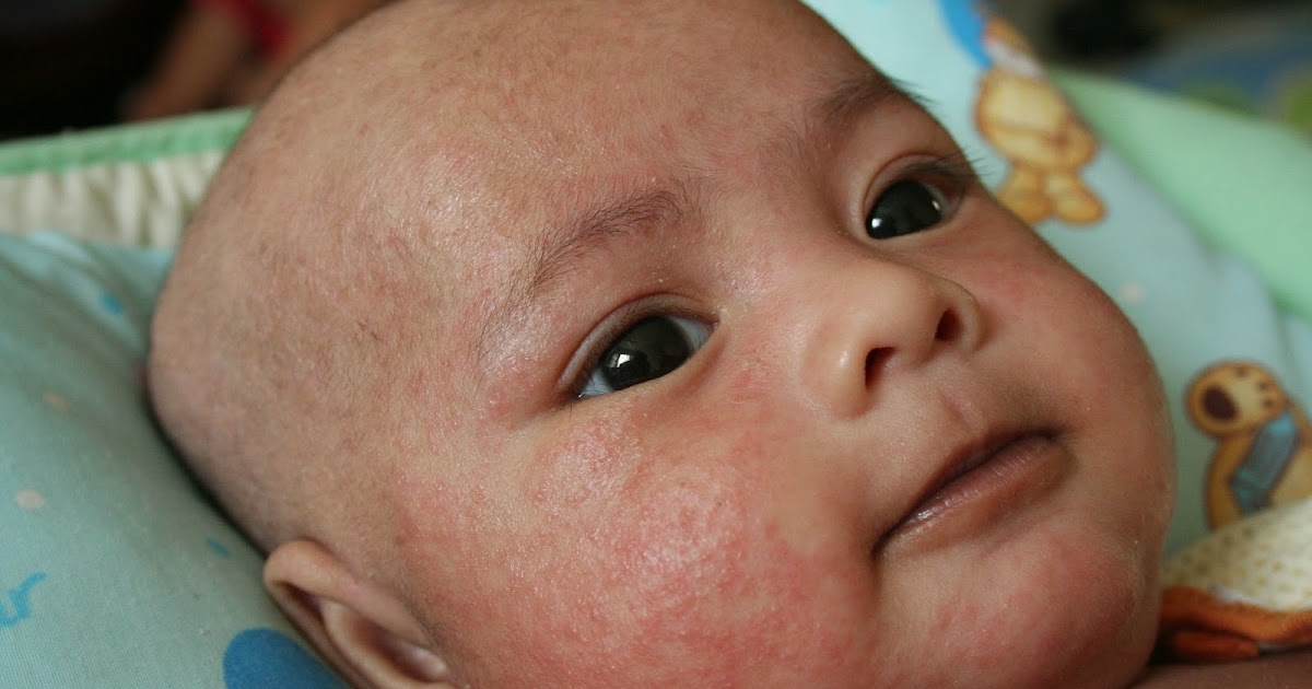 Penyakit Kulit Bayi - Homecare24
