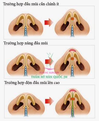 thu-nho-dau-mui-noi-soi-la-the-nao-2