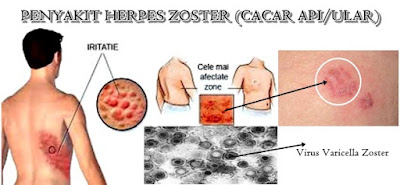 Obat Tradisional untuk Penyakit Herpes Zoster
