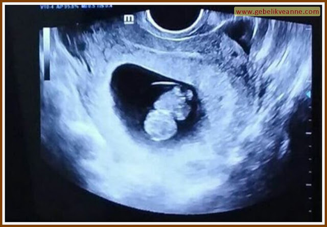 9.hafta ultrason görüntüleri