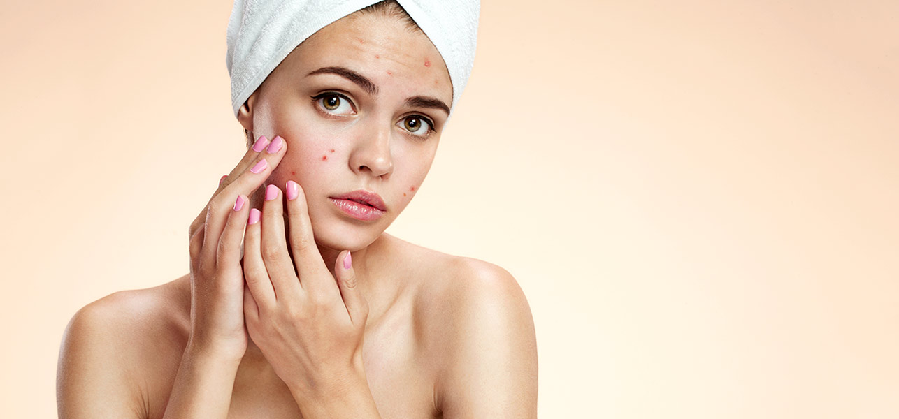 El acné puede presentarse a cualquier edad / WEB