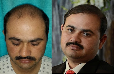 Before and after hair transplant surgery