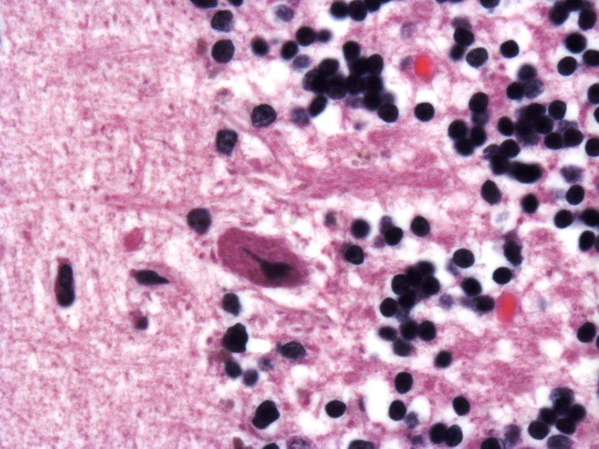 neuropathology blog: Photomicrographs of last month's spinocerebellar