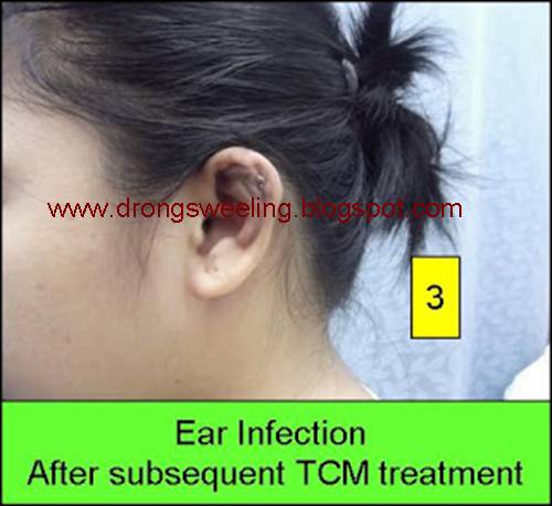 How a Small Earring Can Silently Infect Your Entire Ear