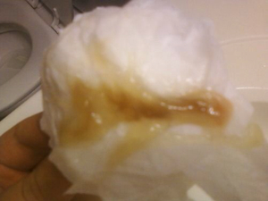 Foto dari penis mengeluarkan nanah dan darah terasa sakit