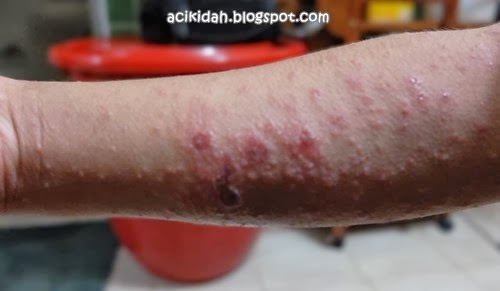Eczema : di bahagian tangan sudah mula menjadi luka kerana digaru. Eczema : di bahagian tangan sudah mula menjadi luka kerana digaru.