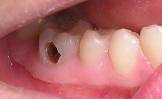 Viêm tủy răng và những điều bạn nên biết
