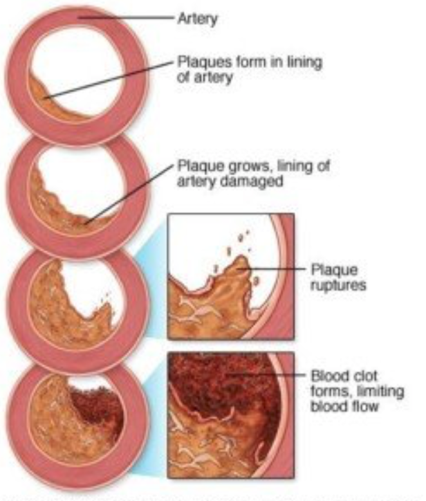 Dr David Grimes Decline of coronary heart disease in three generations