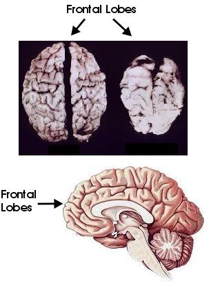 fetus winning: Post 1 - How Badly FAS Children's Brains Are Compromised