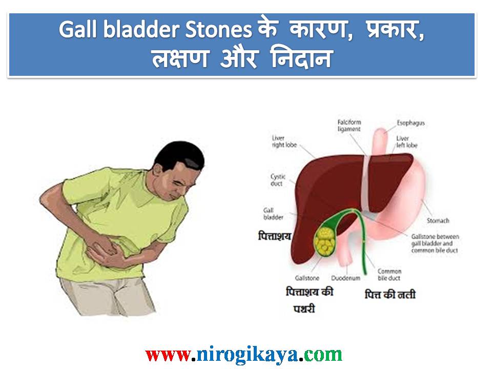 पित्ताशय की पथरी / Gall bladder Stones के कारण, प्रकार, लक्षण और निदान