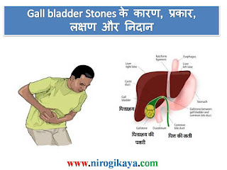 gall-bladder-stones-hindi-causes-symptoms-diagnosis