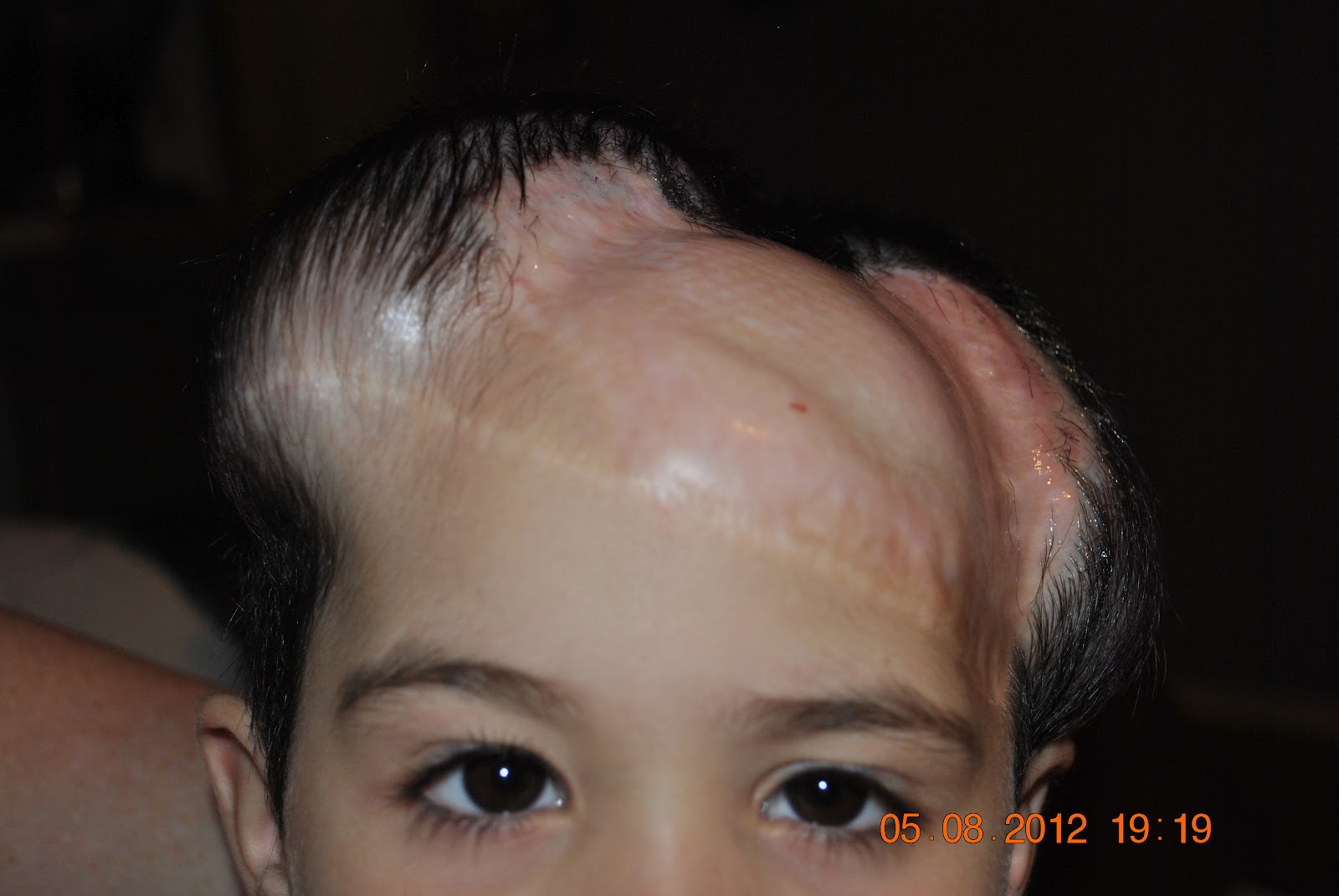 Age 4 Female Scalp Tissue Expanders Eighth Filling