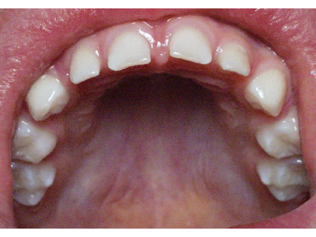 Analytical Armadillo Upper Lip Tie Treatment in Infants