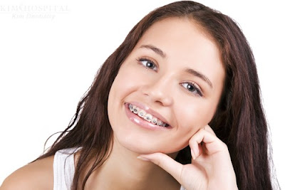 Một số loại hình niềng răng trẻ em phổ biến