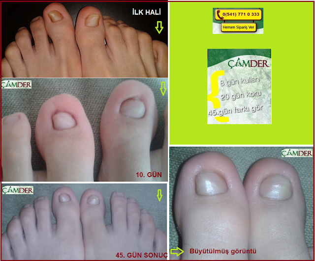 Çamder Tırnak Mantarı (Fungop) Diyeti ÇAMDER Tırnak Mantarı Tedavisi