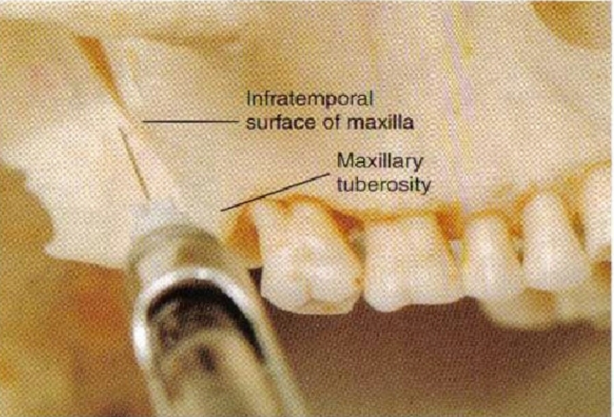 MAXILLARY ANESTHESIA TECHNIQUES