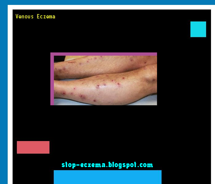 Venous eczema Stop Eczema