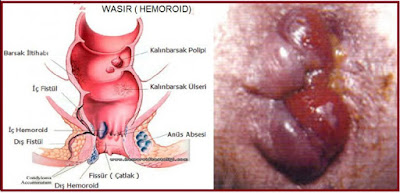 Obat Ambeien Berdarah