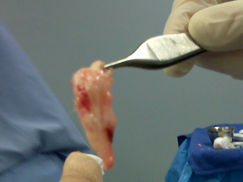 Ledderhose Disease Blog Interview with surgery plantar