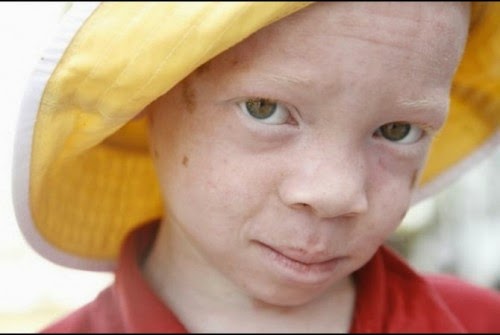 4 Fakta Menyedihkan Manusia Albino di Afrika