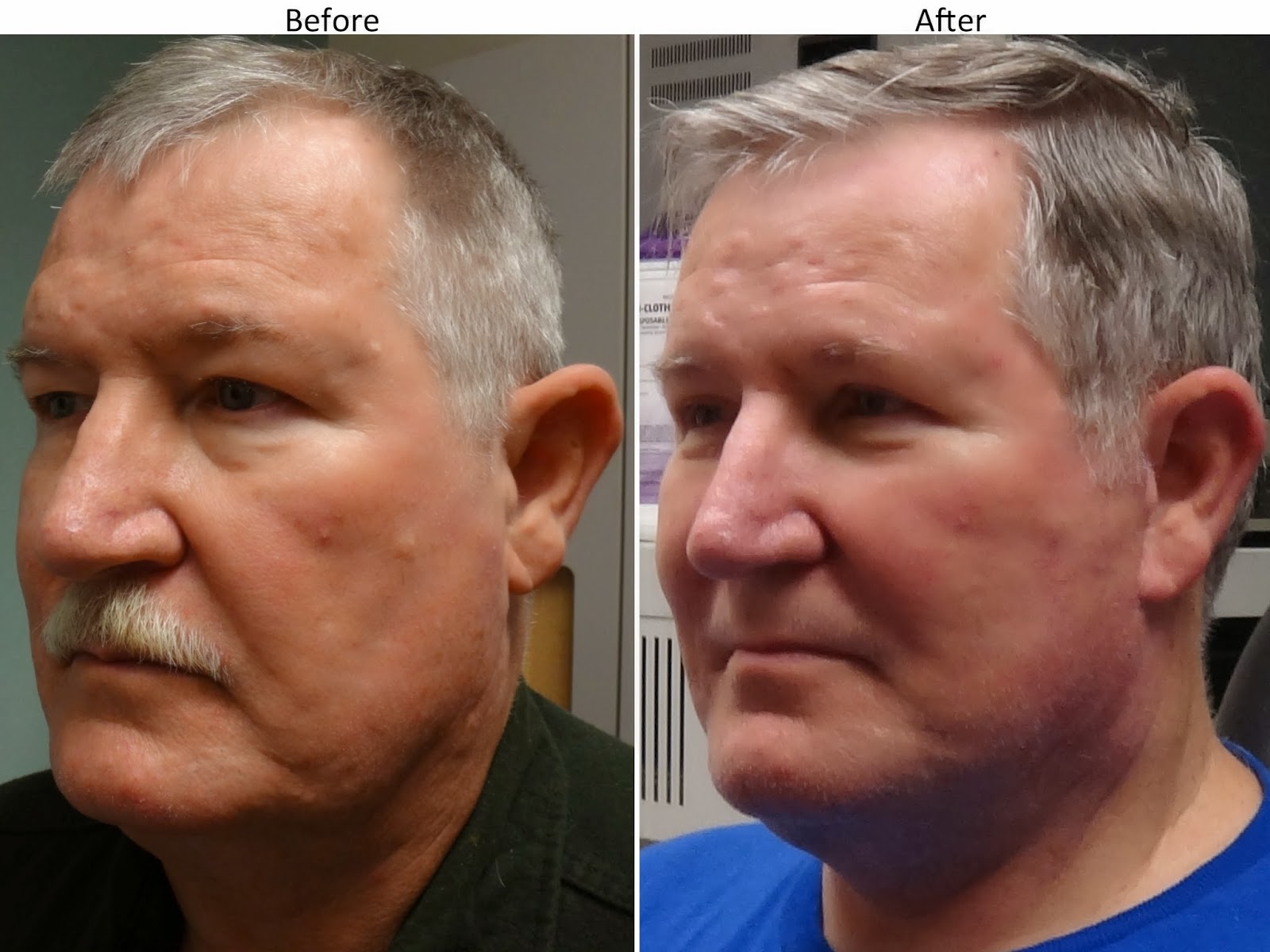 Facial plastic surgery male facelift upper and lower blepharoplasty