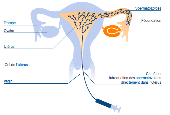 Proses Inseminasi Buatan Proses Inseminasi Buatan